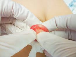 Image result for paraphimosis