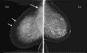 Inflammatory breast cancer does not usually result in a lump in the breast and often mammograms will not detect it. Figure 1 Inflammatory Breast Cancer Pet Ct Mri Mammography And Sonography Findings Springerlink