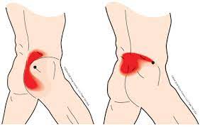 There are ways to treat this condition so that you don't have to live with the pain. Treat Muscle Knots In Lower Back Tiger Tail Usa