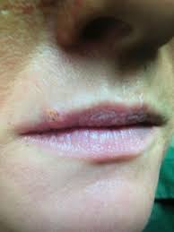 Sccs may look like scaly red patches, open sores, warts or elevated growths with a central depression; Images Of Skin Cancer On Lips