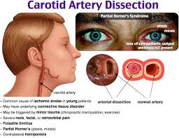 Up to 80% of cervical artery dissections are preceded by trauma to the head or. 9 Carotid Artery Dissection Ideas In 2021 Carotid Artery Arteries Anatomy And Physiology