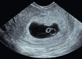 10 weeks pregnant ultrasound 7 week ultrasound pregnancy ultrasound island hospital classroom quotes identical twins baby fever kids and parenting medical. Ultrasound Is A Critical Tool Of Managing Miscarriage