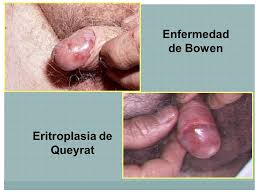 Manchas rojas en la piel. El Peligro De Una Mancha Roja En El Pene Urologia Albella
