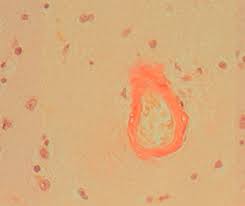 Common diseases for congo red stain include primary amyloidosis, al amyloid seen in plasma cell dyscrasias. Staining Solution Reagent Congo Red Bio Optica Milano For Histology For Cytology