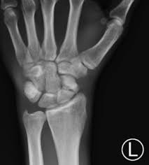 Image result for Hand Fracture