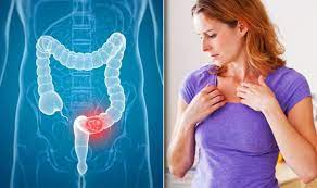 Colon cancer is the third most common cancer in men and women in the u.s. Bowel Cancer Symptoms Signs Of A Tumour Include Having Itchy Skin Express Co Uk