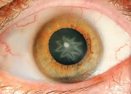 27 Oddest Medical Cases Cataract Medical Eye Health