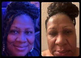 Update: 48 hours in with stomach...