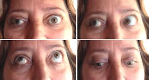 The Enigma of Orbital Compartment Syndrome After Lumbar Spine Surgery in  the Prone Position: Case Report and Literature Review