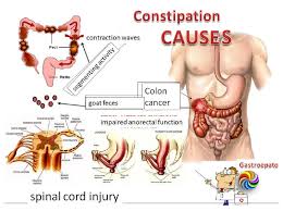 Image result for Constipation Causes