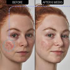 Image result for Azelaic Acid