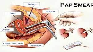 Simak beberapa ulasan di bawah ini. Khusus Wanita Anda Harus Lakukan Pap Smear Demi Mencegah Terjangkit Penyakit Mematikan Ini Halaman All Tribun Jabar