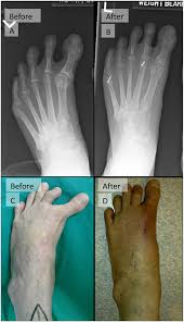 Image result for Hallux Varus