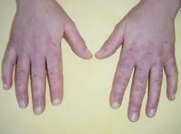 Image result for Chilblains