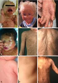 Image result for Ichthyosis