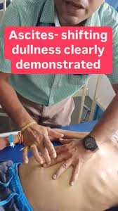 Image result for Shifting Dullness Test