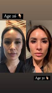 Vision loss is not a normal part of aging — and you can take steps to preserve your sight. 6 Year Progression The Power Of Aesthetic Medicine And I Don T Regret Any Of It R 30plusskincare
