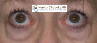 Your Thyroid Can Affect The Appearance Of Eye Bags