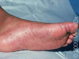Image result for pompholyx soles of feet