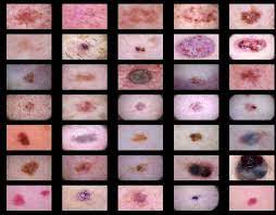 If a spot on your skin looks suspicious to you, there's one cardinal rule: Skin Cancer Dataset Images A Preprocessing In The Preprocessing Stage Download Scientific Diagram