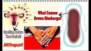 If you have brown discharge instead of a period when you're on birth control therapy, it's a clear sign your body is. Brown Discharge Before Period Causes Youtube
