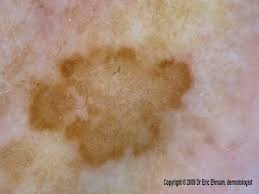 Image result for Solar Lentigo