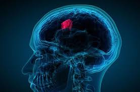 The most common forms of brain tumors are: Recognize The Warning Signs Of Brain Tumour Save A Life