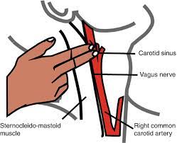 Carotid Sinus Syndrome Springerlink