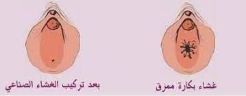 غشاء البكارة posts facebook