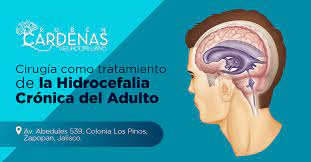 Si a un niño se le diagnostica hidrocefalia congénita, el médico del niño probablemente le instalará una derivación en el cerebro para drenar el exceso de líquido. Hidrocefalia Cronica Del Adulto Dr Ruben Cardenas