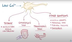 Chvostek sign is seen in cases of hypocalcemia (tetany). Runthelist On Twitter How Do We Identify Hypocalcemia On Physical Exam 1 Chvostek S Sign Tap The Facial Nerve As It Runs Through The Parotid Gland Ipsilateral Facial Muscles Twitch