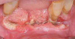 Image result for gums cancer symptoms
