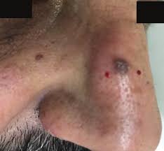 Image result for Neurotic Excoriation