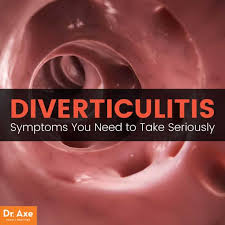 Image result for Diverticulitis