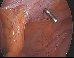 We offer pontoon boats, fishing boats, sailboats, kayaks, canoes, petal boats and sups. Left Lateral Port Safe Laparoscopic Port Entry In Previous Large Upper Abdomen Laparotomy Scar Journal Of Minimally Invasive Gynecology