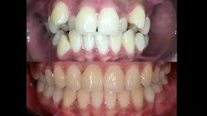 Pakai braces sampai gigi jarang prs speaker's corner : 3 Klinik Pergigian Terbaik Kepong Harga Ulasan
