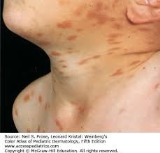 Image result for Urticaria pigmentosa children