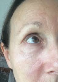 Some scars are atrophic, which means they are sunken or pitted. Facial Skin Cancer Excision Wound Care And Scar Minimisation 800 Words Or Less
