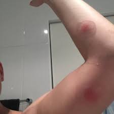 But how do you work out what bit you in the first place? A White Tail Spider Bit Me Seven Times While I Was Asleep