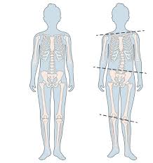 Image result for Functional Leg Length Discrepancy