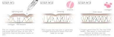 Plamere Plasma Pen Fibroblast Skin Tightening Training Empire