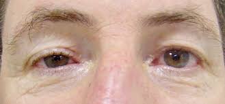 Image result for Pupillary Paralysis