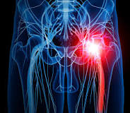 Ask Dr. Rob about piriformis syndrome - Harvard Health