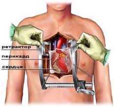 Stentirovanie Koronarnyh Arterij Gkb 71