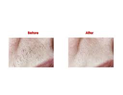 Sorgente medspa and all cape gynecology Laser Hair Removal Clinic Harley Street London
