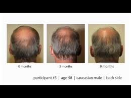 Its benefit appears to be mainly in treating the scalp and various conditions that affect the scalp, which further reinforces its capacity as a skin treatment. Aloe Vera For Hair Growth Reviews