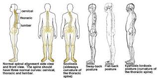 How To Improve Posture For A Healthy Back Good Posture Cleveland Clinic Scoliosis Exercises Improve Posture Good Posture