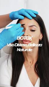 💉 Botox: Freschezza e Bellezza Naturale ,  Con il Dott. Alessandro Carraro  di TreviMedical puoi dire addio a rughe e segni del tempo, mantenendo  l’armonia naturale del tuo viso. , Grazie alla sua ...