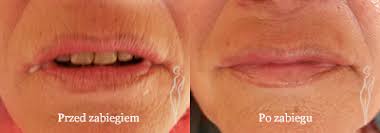 Zmarszczki palacza to drobne, pionowe zmarszczki pojawiające się w okolicy ust. Kwas Hialuronowy Botox Wroclaw Botoks Powiekszanie Ust Botox Usuwanie Zmarszczek Kwas Hialuronowy Wroclaw
