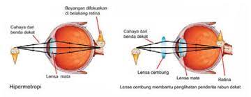 Titik jauh adalah jarak terjauh yang dapat. Cacat Mata Mutiaraadiesta